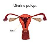 Uterine polyps, illustration