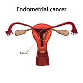 Endometrial cancer, illustration