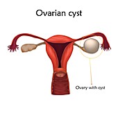 Ovarian cyst, illustration
