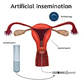 Artificial insemination, illustration