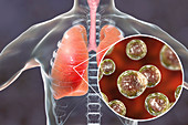 Pulmonary blastomycosis, conceptual illustration