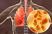 Pneumonia caused by Haemophilus influenzae bacteria, illustr