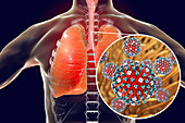 Flu viruses in trachea, illustration