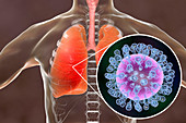 Pneumonia caused by flu, illustration