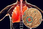 Pneumonia caused by measles viruses, conceptual illustration