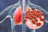 Pneumonia caused by Streptococcus pneumoniae bacteria, conce