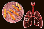 Cavernous pulmonary tuberculosis, illustration