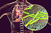 Secondary tuberculosis infection, illustration
