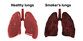 Healthy and smoker's lungs, illustration