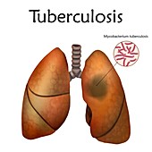 Tuberculosis, illustration