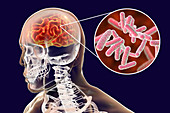 Bacterial encephalitis, illustration