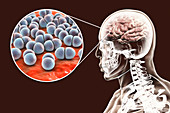 Brain infection caused by Streptococcus pneumoniae bacteria,