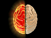 Migraine, conceptual image