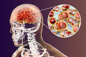 Neisseria meningitidis brain infection, illustration