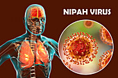 Encephalitis and pneumonia caused by Nipah viruses, illustra