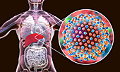 Hepatitis C infection, illustration