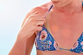 Woman with sunburnt chest