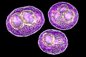 Cytomegalovirus infection, illustration