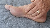 Man rubbing sore foot