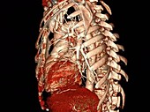 Heart disease and lung collapse, rotating 3D CT scan