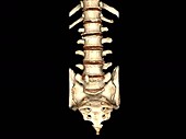 Lumbar spine degeneration, rotating 3D CT scan