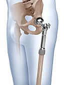 Proximal femoral replacement, illustration