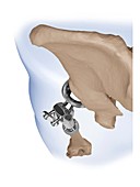 Proximal femoral replacement, illustration