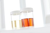 Blood in human urine in sample pot