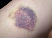 Bruise on thigh following a fall