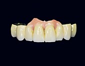 Dental ceramic bridge with artificial gums