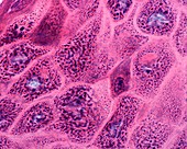 Hyperkeratosis, light micrograph