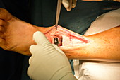 Total ankle replacement surgery