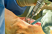 Total ankle replacement surgery