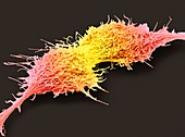 Brain cancer cells, SEM