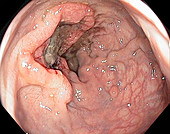 Colon cancer, endoscope view
