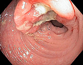 Colon cancer, endoscope view