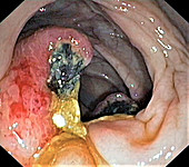 Colon cancer, endoscope view