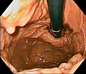 Hiatus hernia and hyperplastic polyps, endoscope view