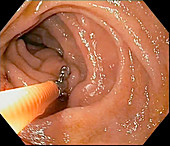 Small intestine biopsy, endoscope view