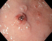 Ulceration in gastric lymphoma, endoscope view