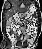 Crohn's disease, MRI scan