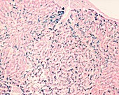 Liver haemochromatosis, light micrograph