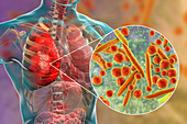 Pneumonia caused by bacteria Mycoplasma pneumoniae, illustra