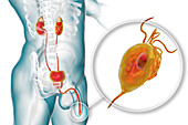 Trichomoniasis, illustration