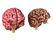 Illustration of a healthy and unhealthy brain