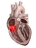Illustration of a diseased heart valve