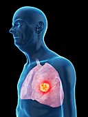 Illustration of an old man's lung cancer