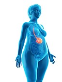 Illustration of an obese woman's stomach