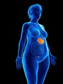 Illustration of an obese woman's spleen