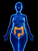 Illustration of an obese woman's colon